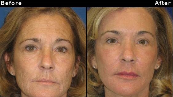Before & After